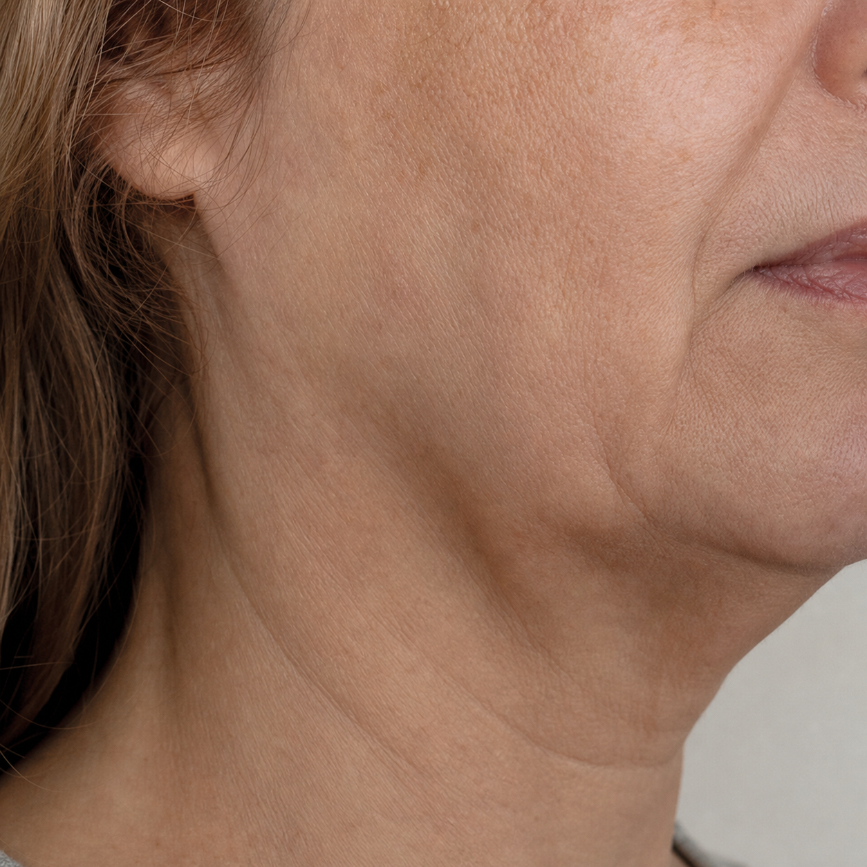 Close-up of sagging skin and jawline loss on mature skin